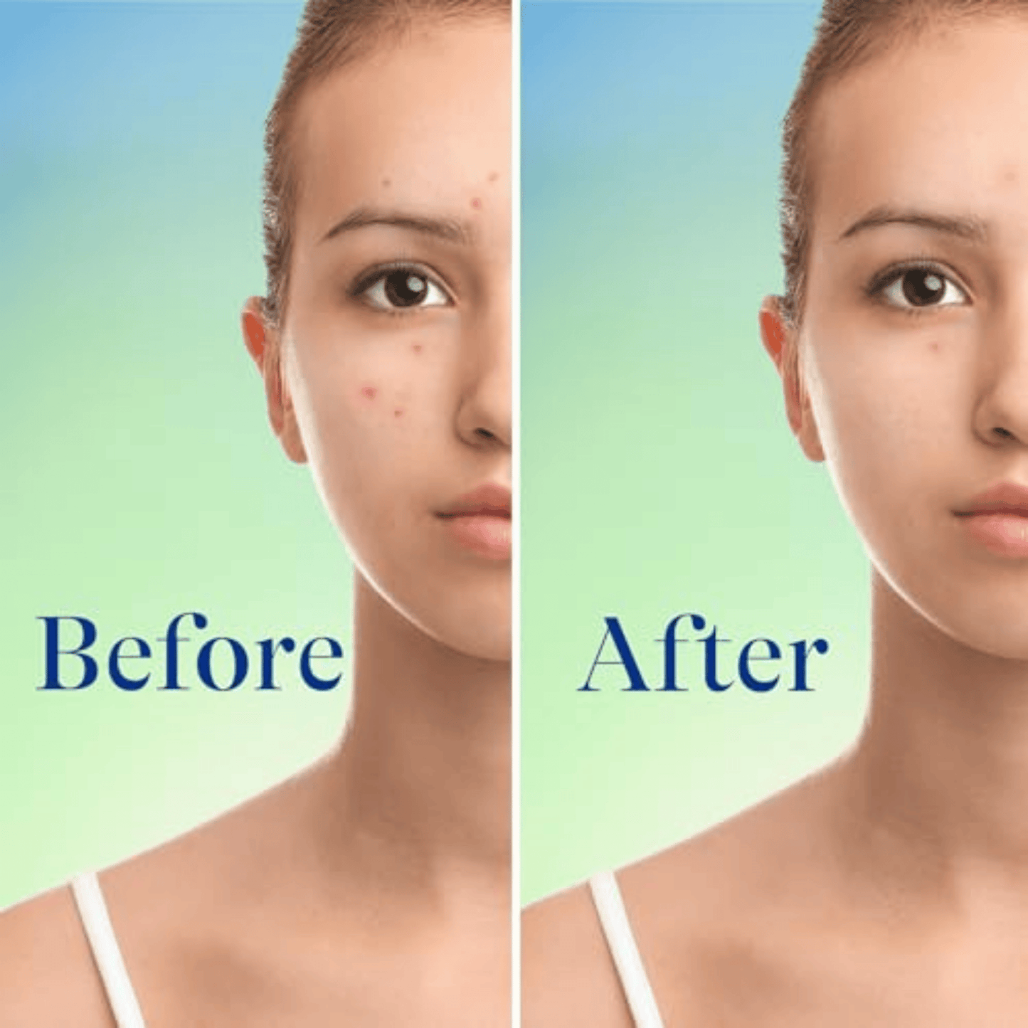 Differin 10% Benzoyl Peroxide Acne Foaming Cleanser (148ml)