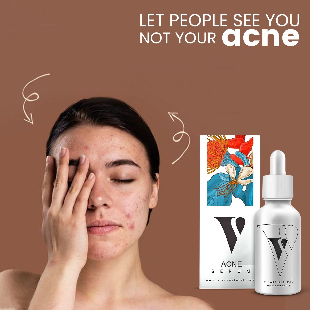 VCare Natural Acne Serum