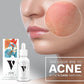 VCare Natural Acne Serum