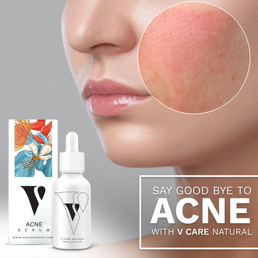 VCare Natural Acne Serum